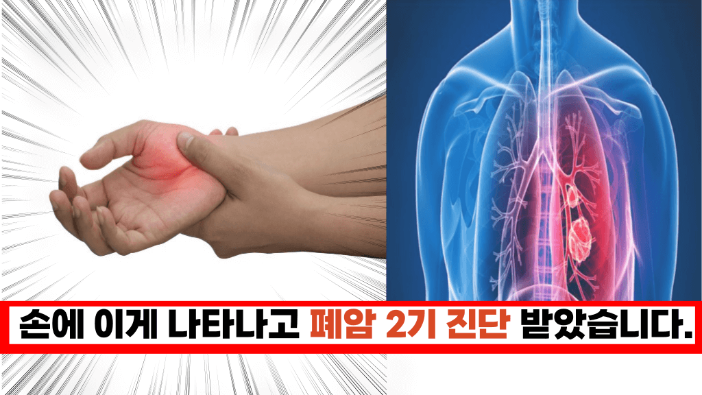 ‘절대 그냥 지나치지 마세요’ 폐암이 전이 될때 손에 나타나는 심각한 증상들