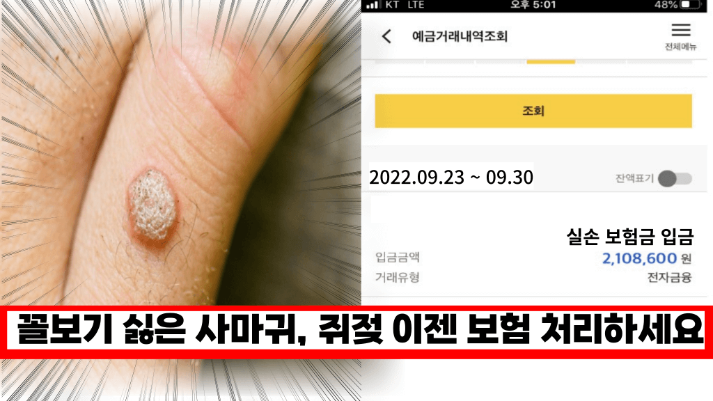 사마귀,쥐젖 피부과에서 실비 보험 처리 됩니다. 아는 사람만 보장 받는 비법