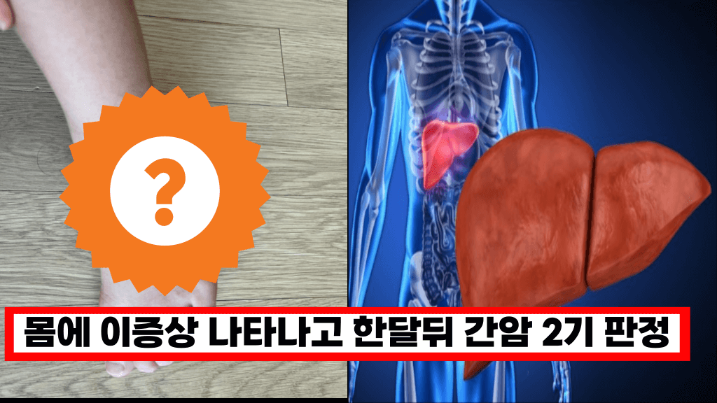 ‘몸에 이 증상 나타나면 간이 망가지는 신호입니다’ 간이 완전히 망가져 갈때 나타나는 증상