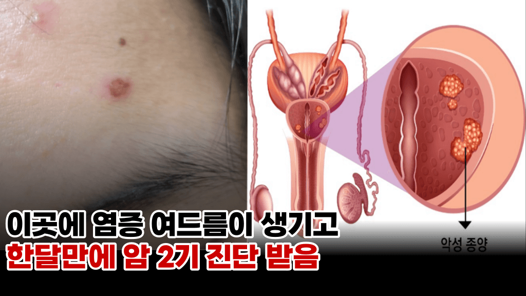 이곳에 발생하는 여드름, 사실은 암의 전조 증상