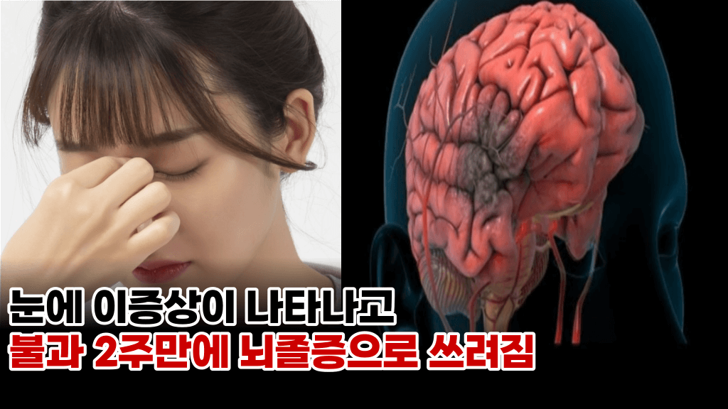 ‘최악의 경우 심정지로 사망할수 있는’ 뇌졸증을 예방할수 있는 전조증상