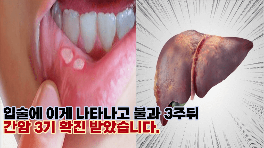 ‘몸에 암세포가 쫙 퍼졌어요’ 간암이 퍼질때 나타나는 우리몸의 증상