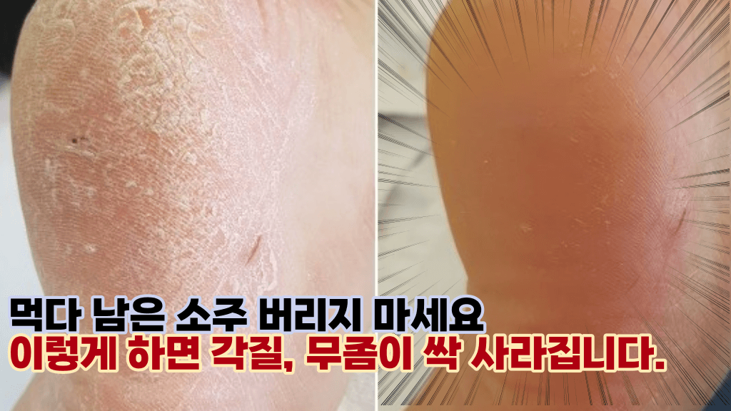 이것 하나로 내발을 괴롭히는 각질 무좀을 확실히 날려버렸습니다.