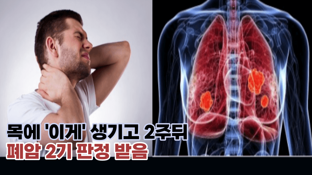 바로 ‘이것이’ 폐속에 암이 자라고 있는 신호입니다. 바로 병원가세요.