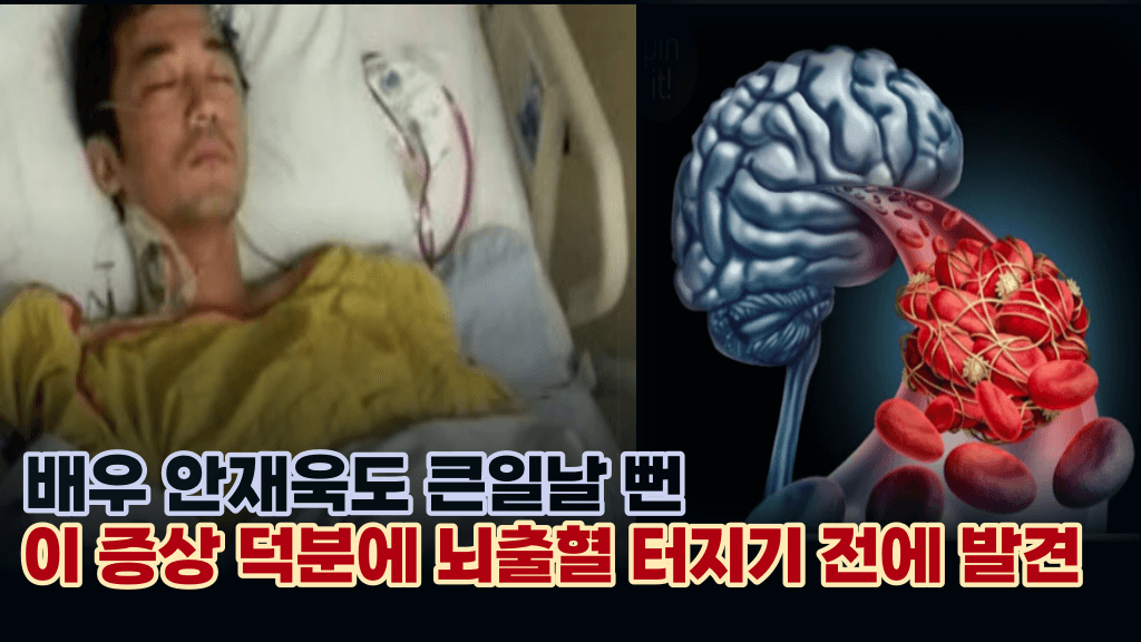 안재욱 긴급 뇌수술, 큰일날뻔 뇌출혈 생기기 전에 우리몸에서 보내는 조기신호