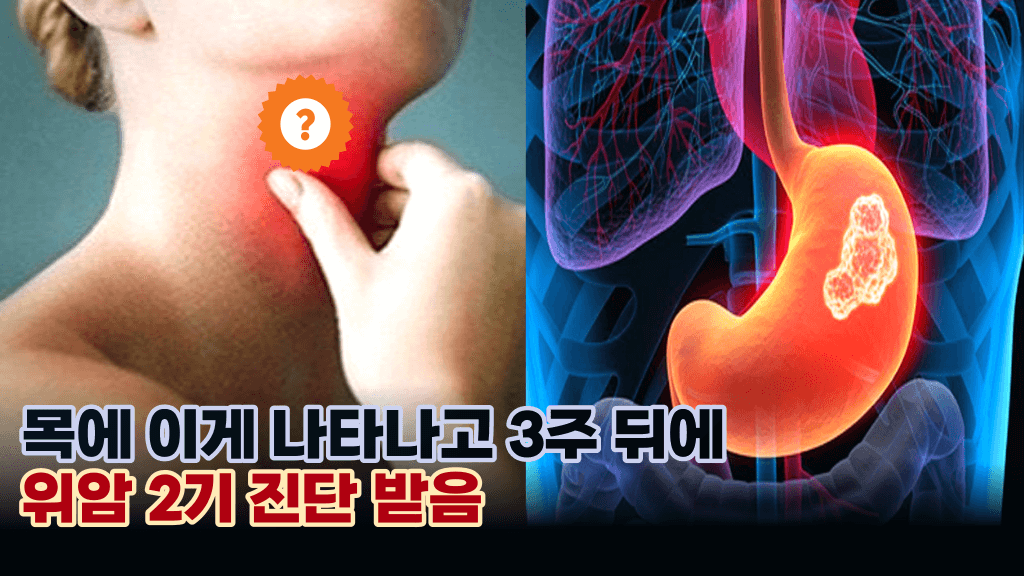 고민할 필요 없이 바로 병원 가야 하는 최악의 위암 초기 증상