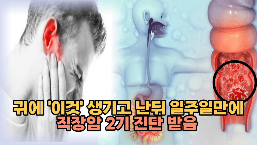 귀에 ‘이것’ 생기면 그 독한 암세포가 직장에 쫙 펴집니다. 바로 병원가세요