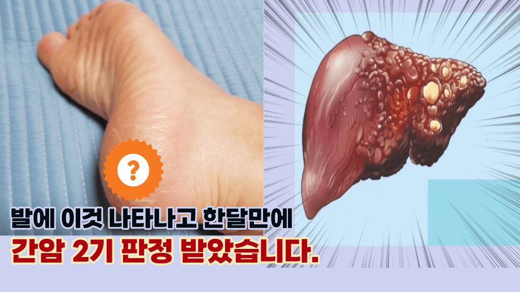 ‘바로 병원 가세요.’ 간암이 생기기 시작하면 나타나는 우리 몸의 초기 증상