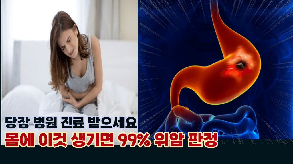 정말 놓치면 생존율 10% 미만, 위암 발병 조기 증상