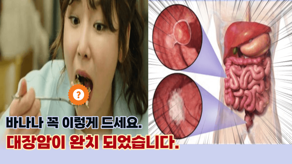 바나나 이렇게 먹으면 암세포를 사멸 시켜버립니다.