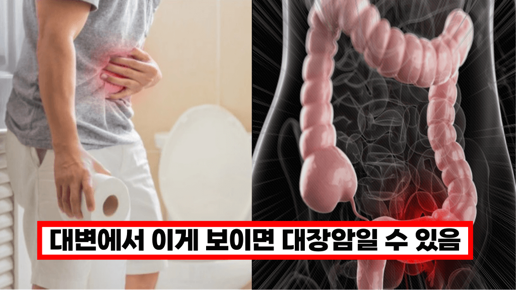 ‘이게 보이면 바로 병원 가세요’ 전문의가 말하는 대장암의 징조