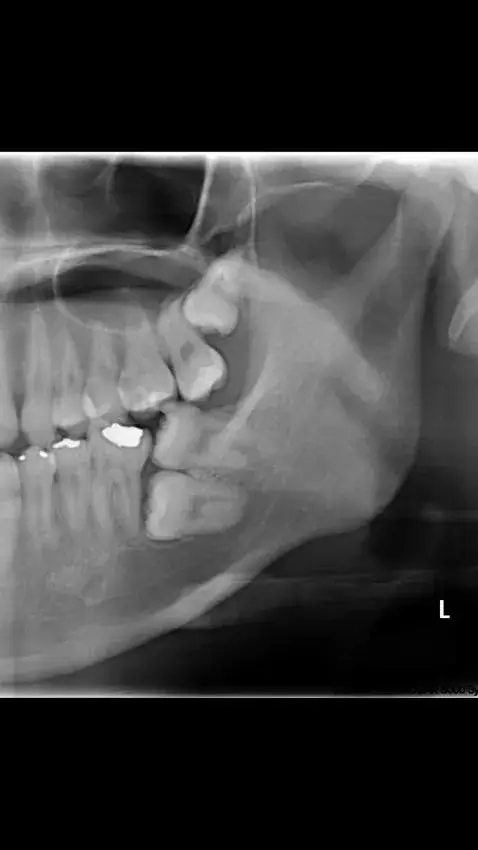 귀뚫고 간지러움 해결 귀뚫고 간지러움 해결