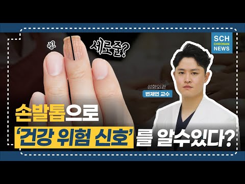 엄지 손톱 검은 세로줄 왜 생기는 걸까? 엄지 손톱 검은 세로줄 왜 생기는 걸까?